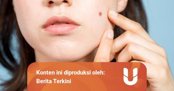 Cara Menghilangkan Bekas Jerawat Hitam di Pipi dengan Skincare